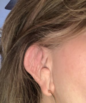 Oreja caída en la policondritis recidivante