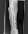 Galeazzi Fracture
