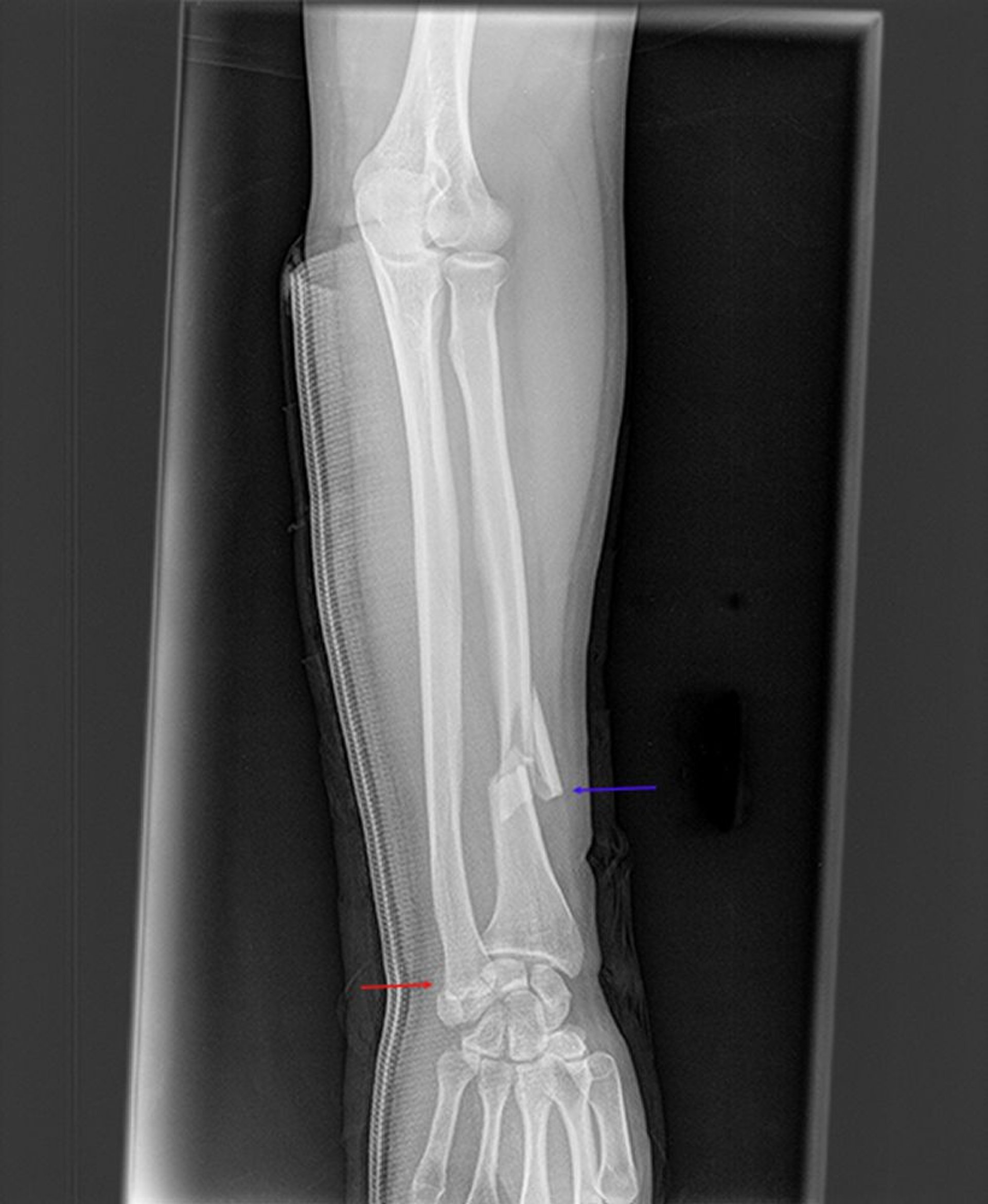 Fracture de Galeazzi