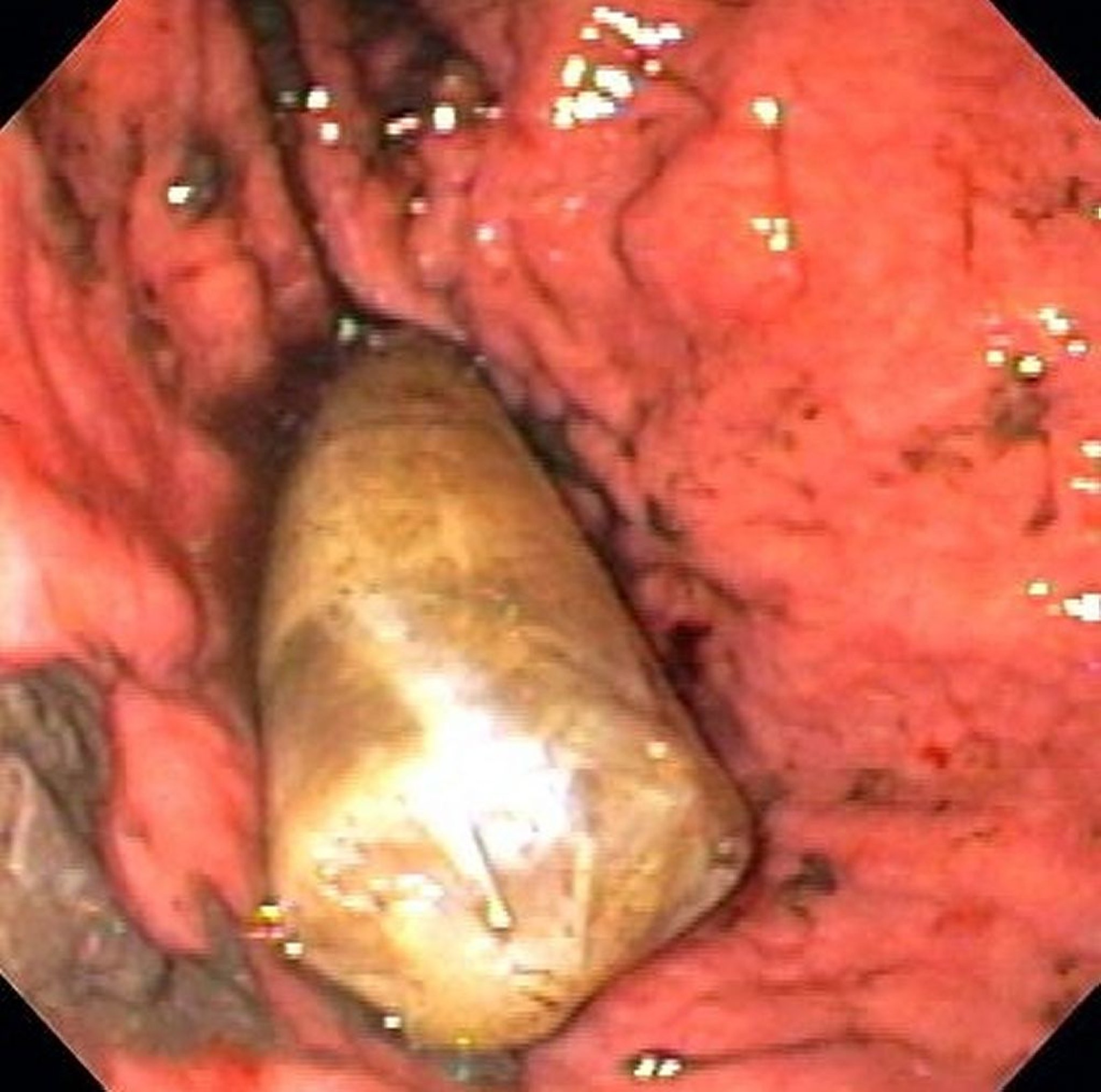 Corpo estranho gástrico (endoscopia)