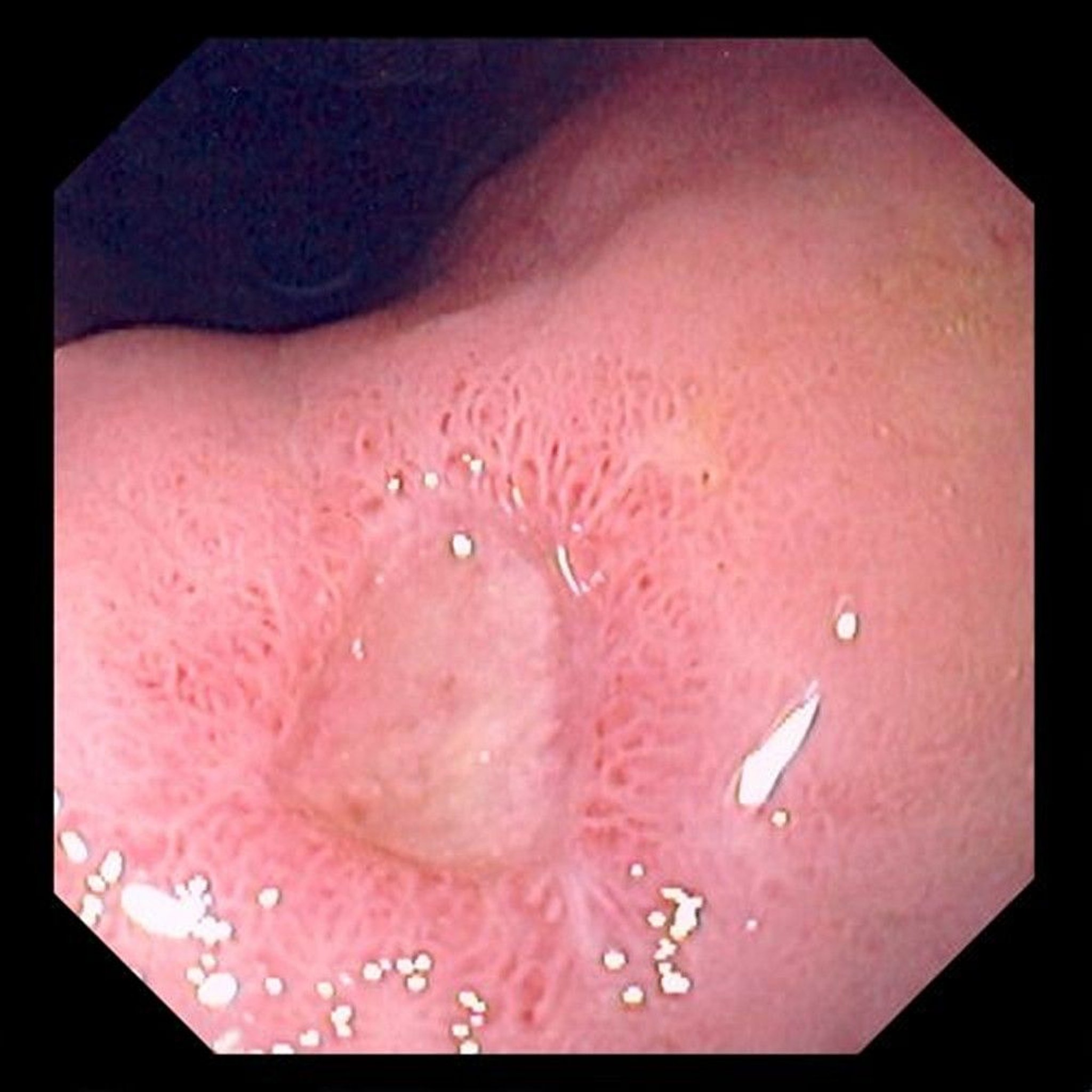 Gastric Ulcer