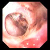 Perforation d'un ulcère gastrique