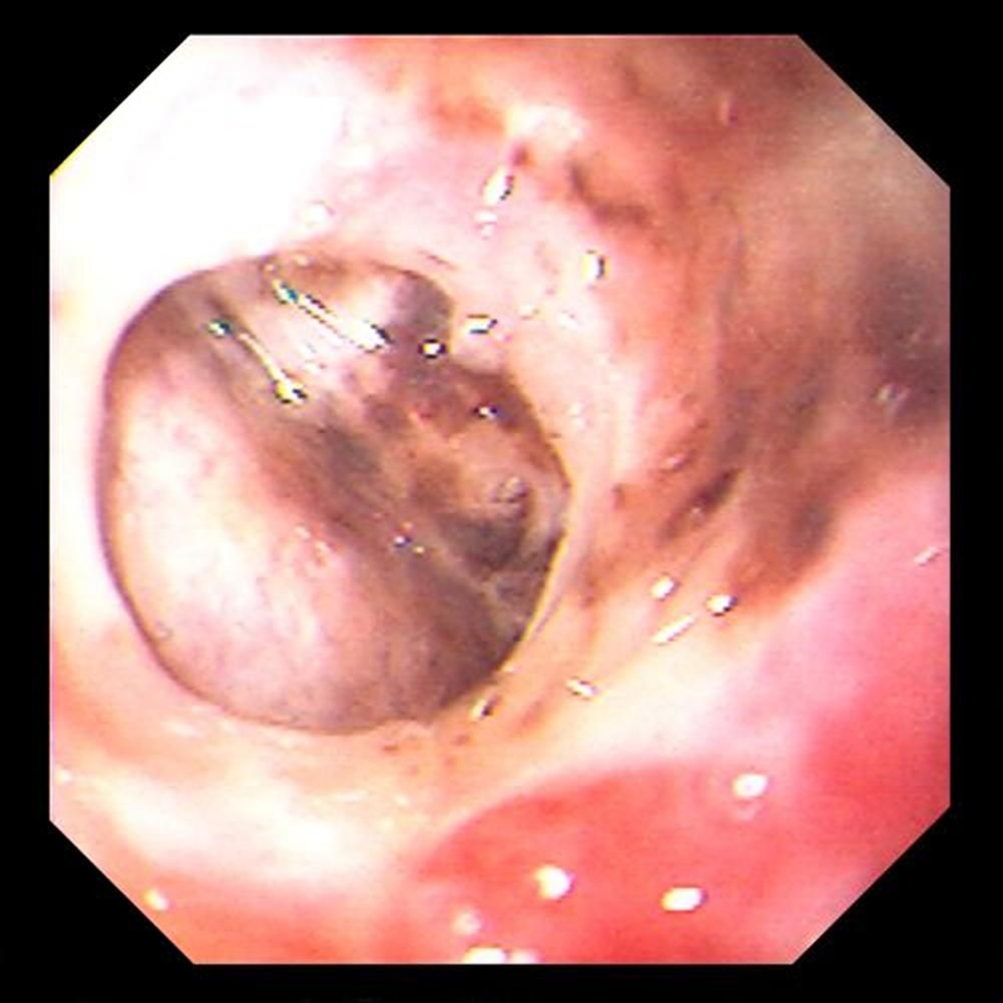 Perforation d'un ulcère gastrique
