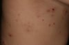 Molluscum Contagiosum (Torso)