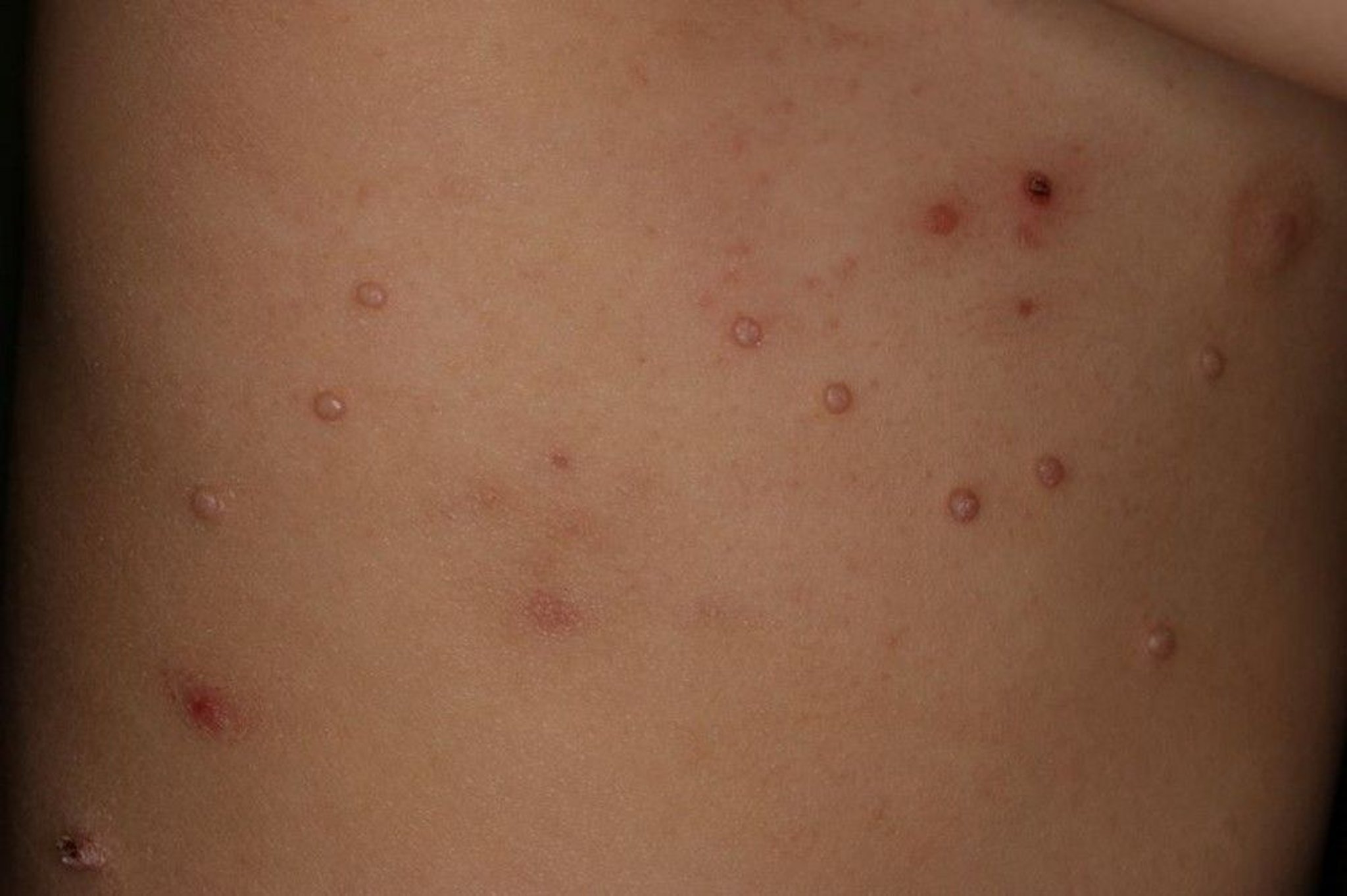 Molluscum Contagiosum (Torso)