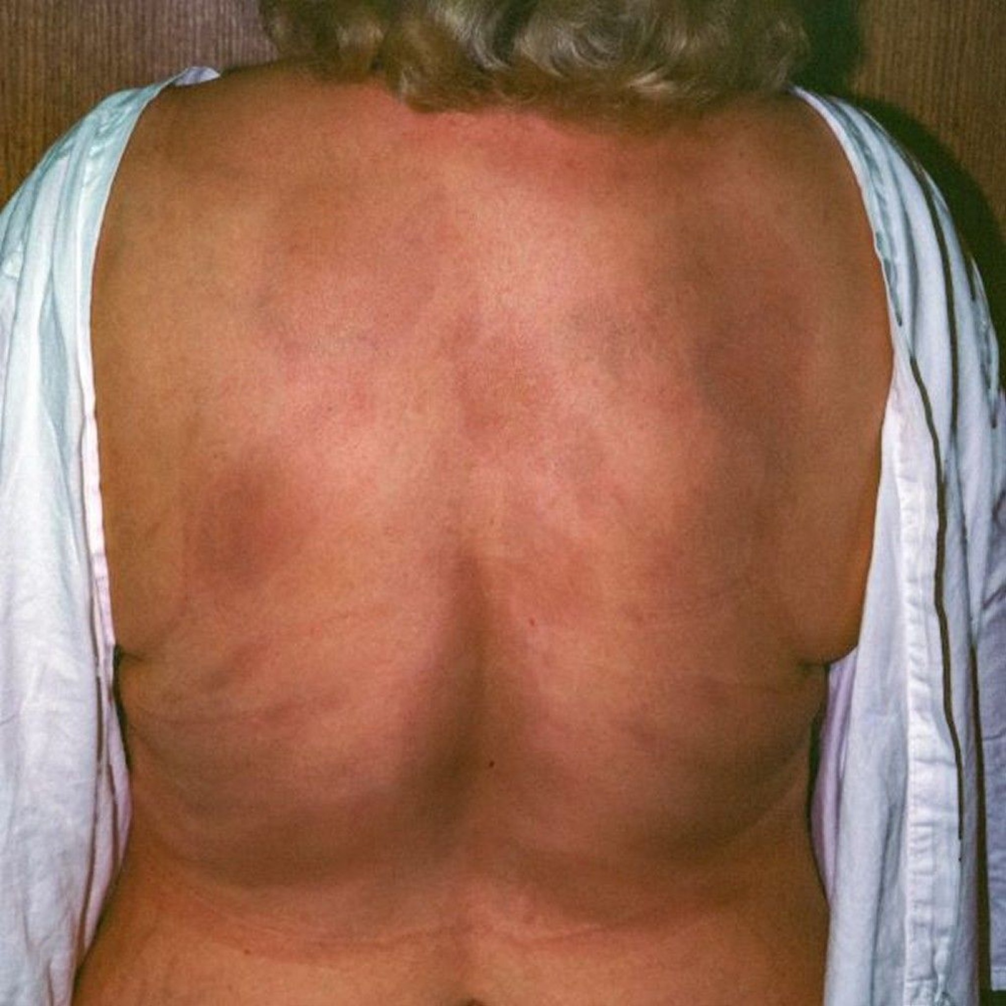 Morphea