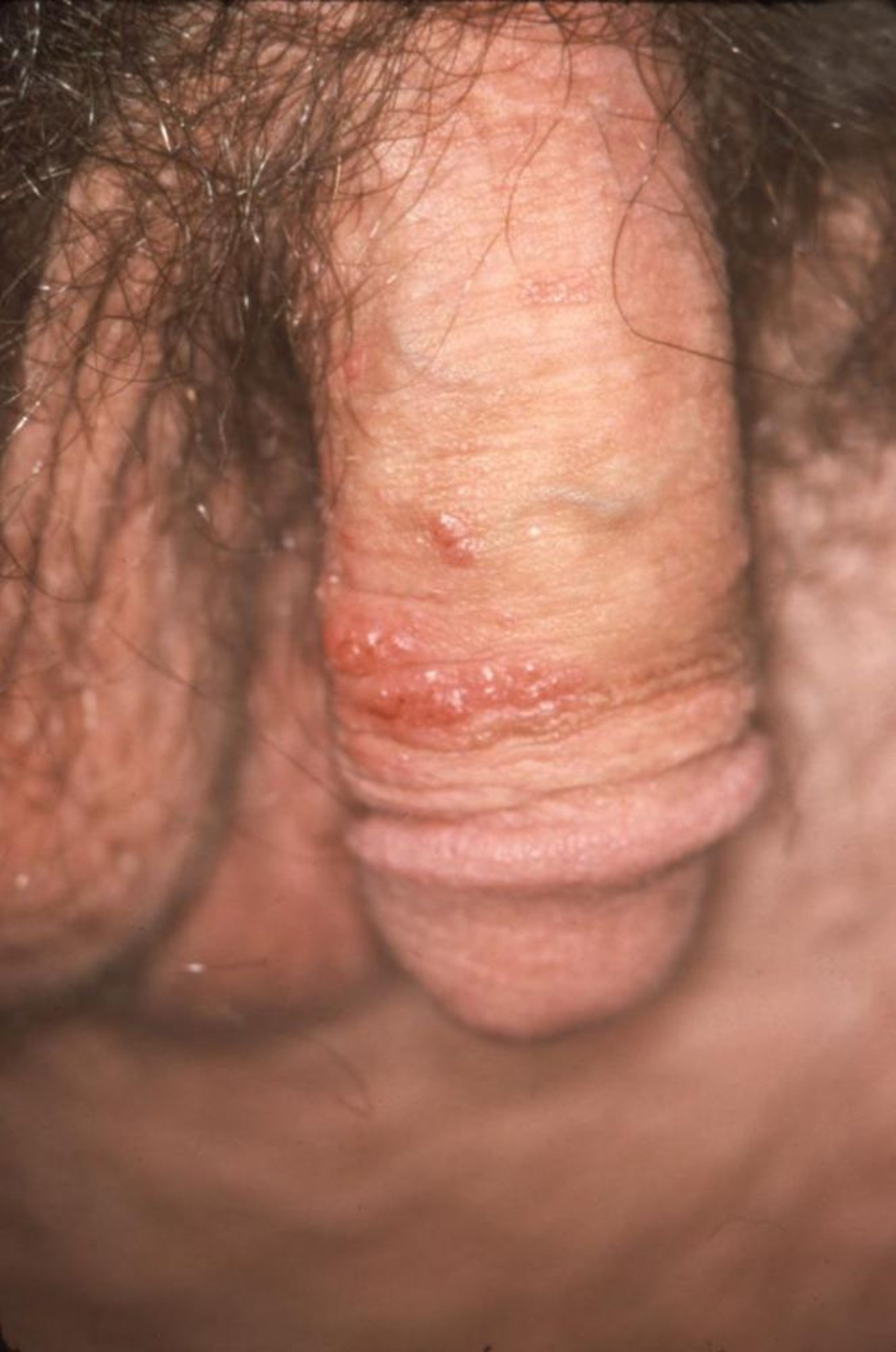 尖圭コンジローマ（男性）