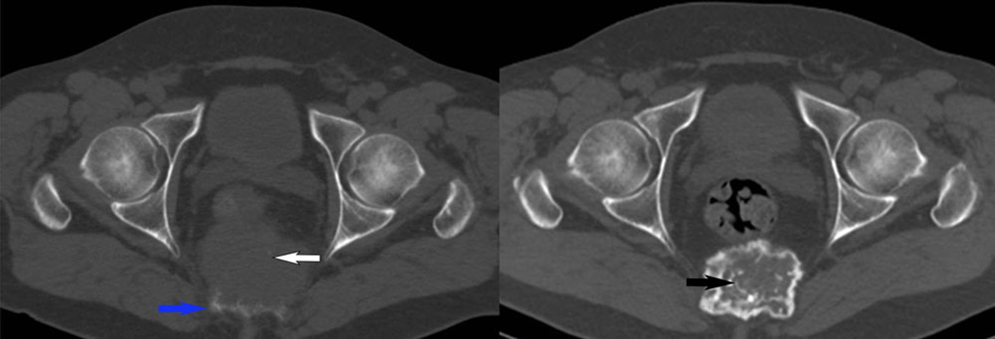Giant Cell Tumor of Bone (CT Scan)