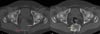 Tumore osseo a cellule giganti (scansione TC)