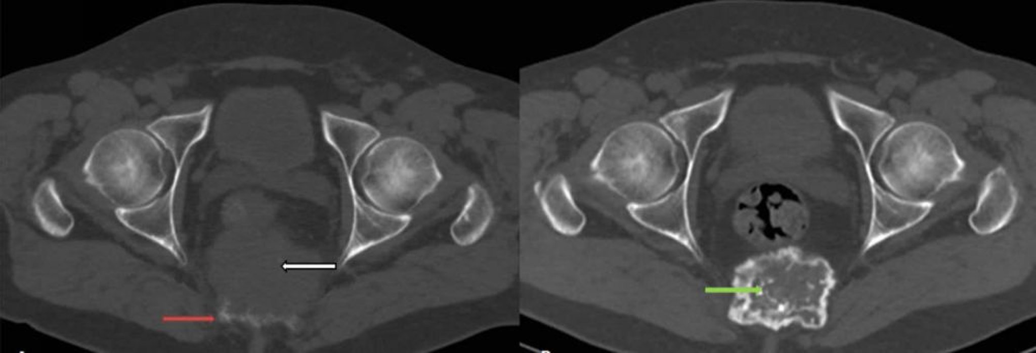 Tumore osseo a cellule giganti (scansione TC)