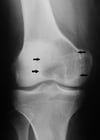 Tumeur à cellules géantes
