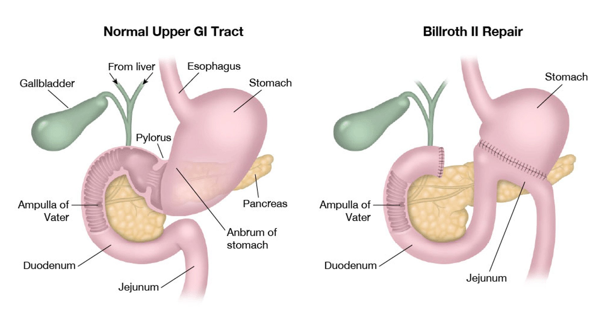Billroth-II-Resektion