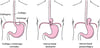 Hernia de hiato