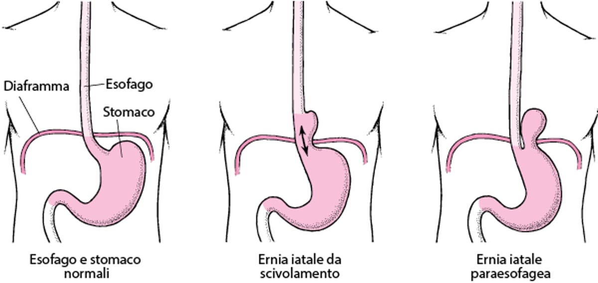Comprendere l'ernia iatale