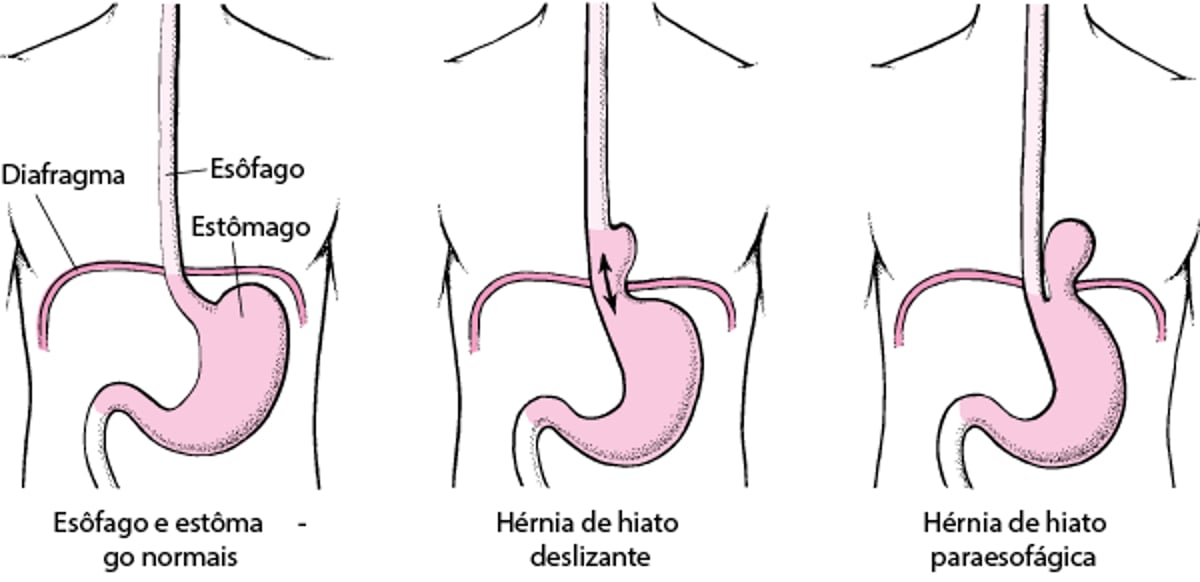 Entendendo a hérnia de hiato