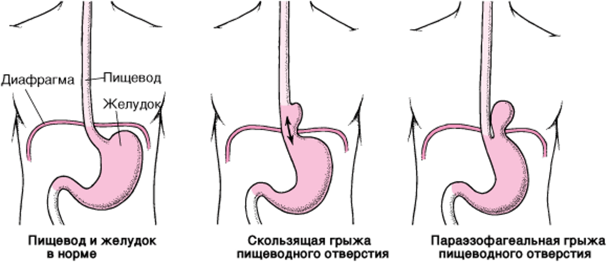 Понимание паузальной грыжи