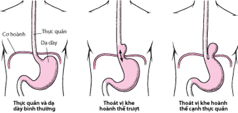 Tìm hiểu về thoát vị qua khe hoành