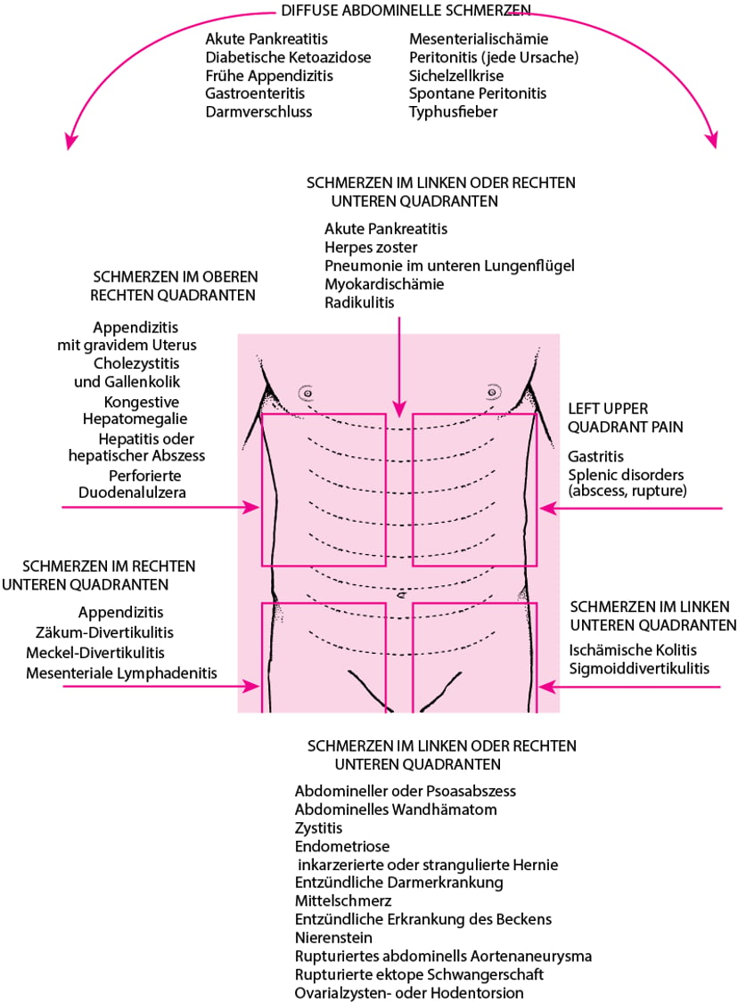 Akuter Bauchschmerz Gastrointestinale Erkrankungen MSD Manual Profi akuter-bauchschmerz-gastrointestinale-erkrankungen-msd-manual-profi