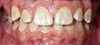 Gingivitis