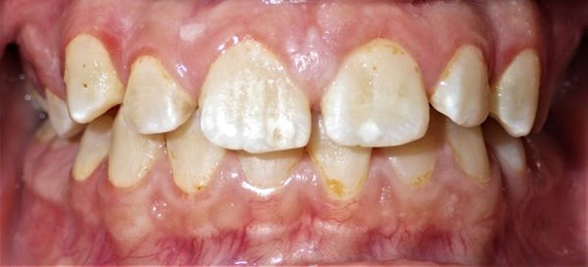 Gingivite