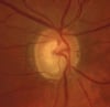 Glaucoma (moderato)