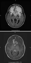 Glioblastoma