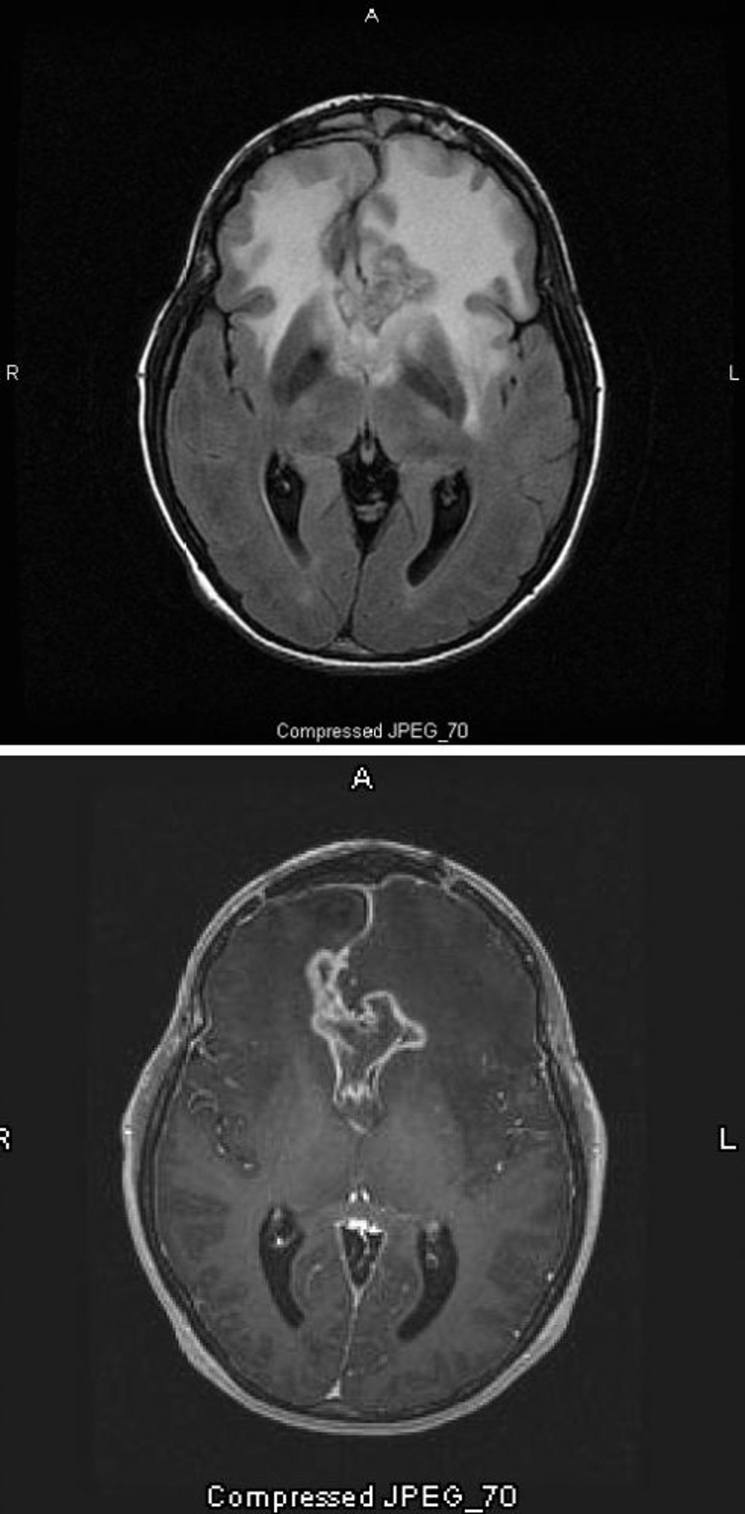 Glioblastoma