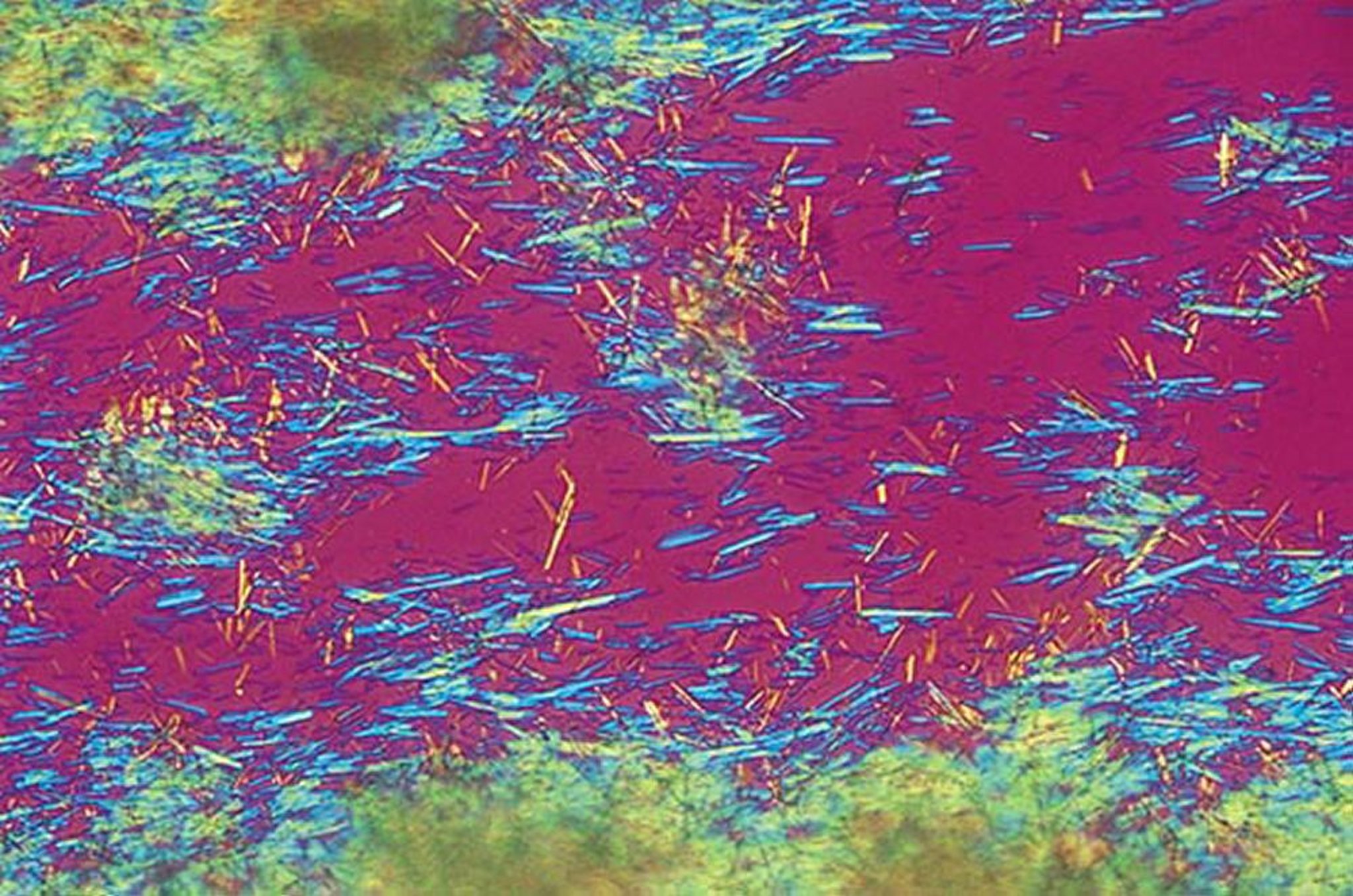 Cristales de urato en la gota