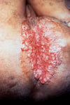 Granuloma inguinal (perianal)