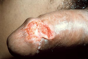 Granuloma inguinal (Homens)