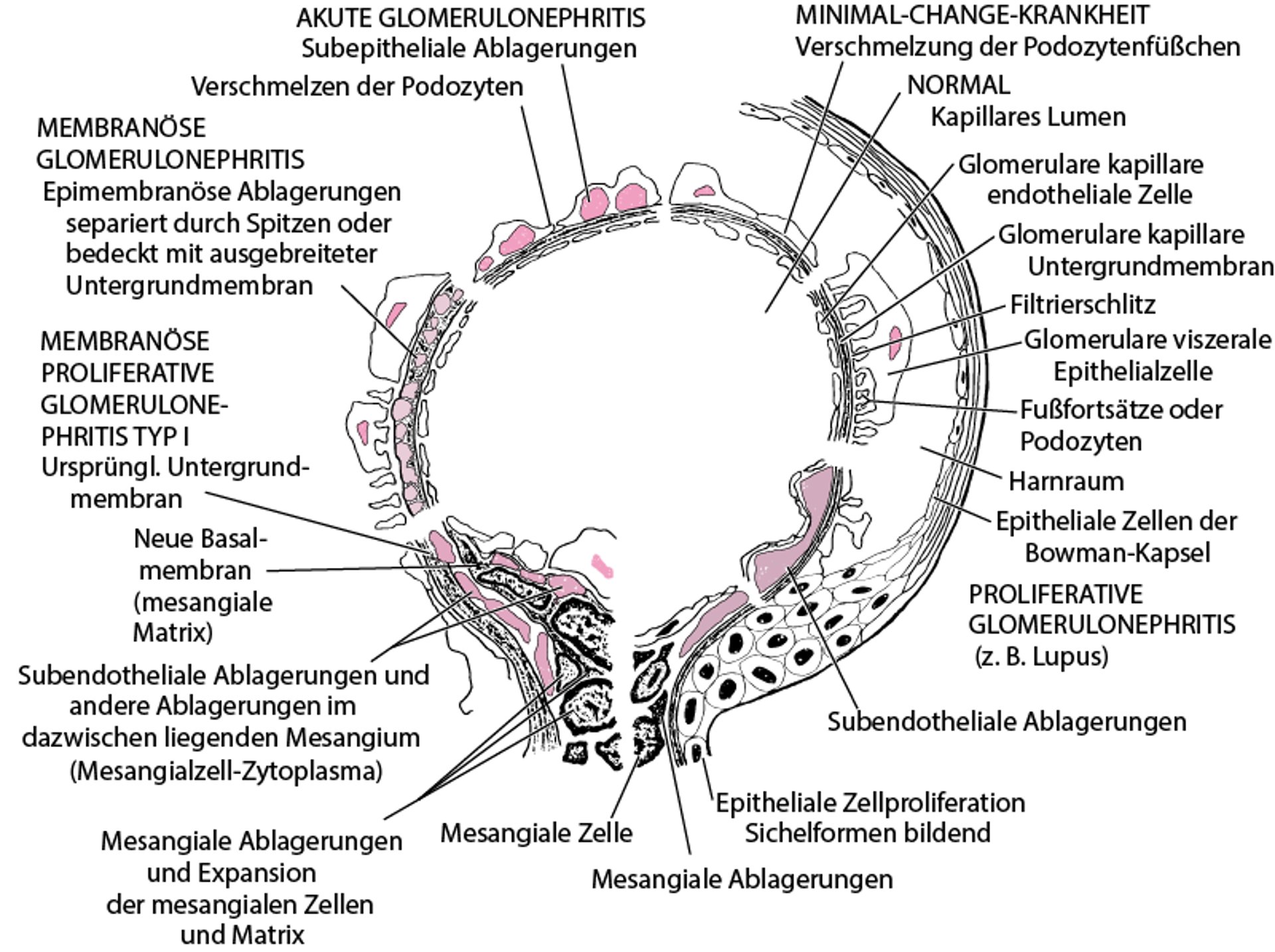 Elektronenmikroskopische Kennzeichen bei immunologischen glomerulären Erkrankungen