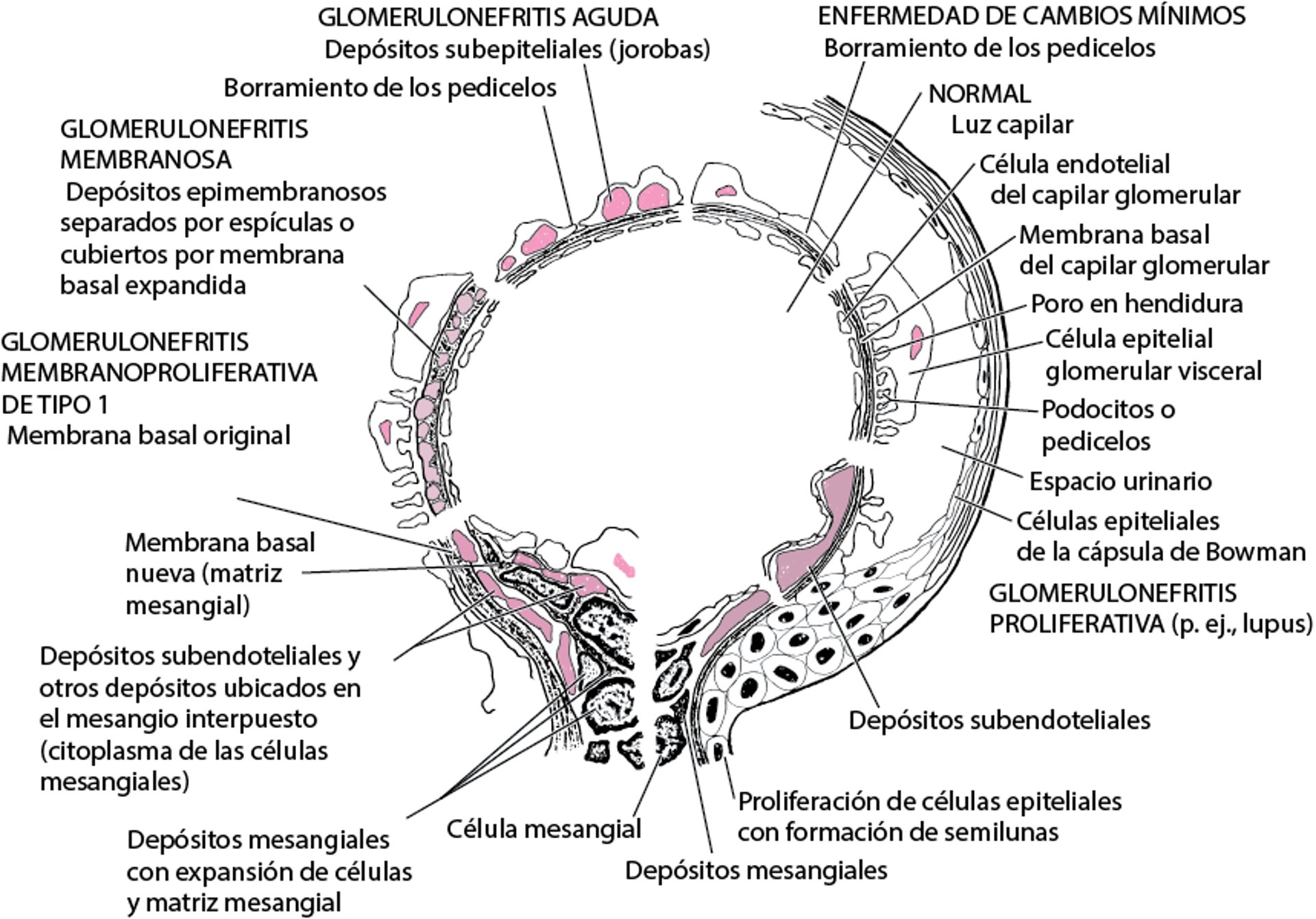 Características de los trastornos glomerulares inmunitarios en la microscopia electrónica