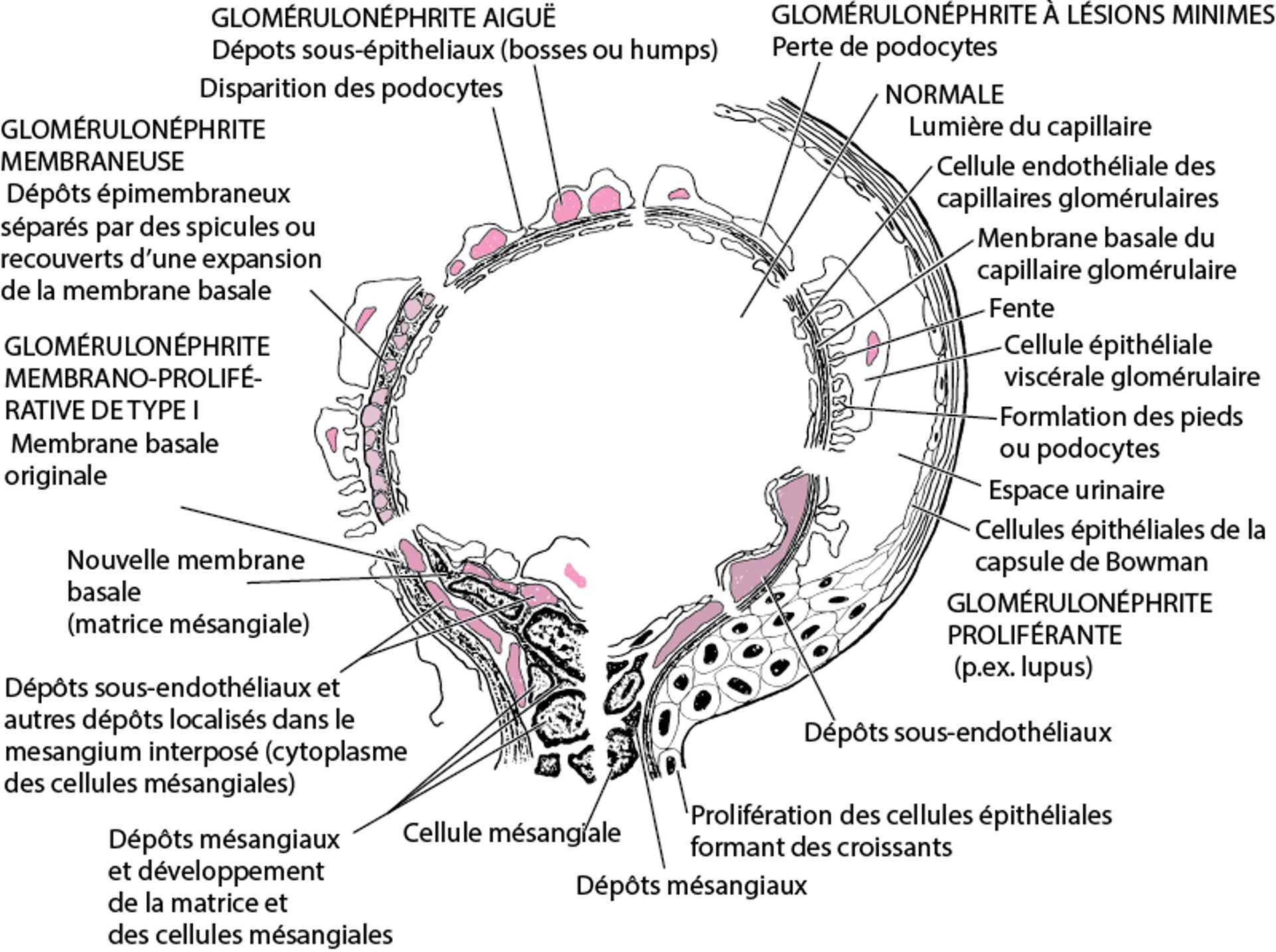 Caractéristiques en microscopie électronique des troubles immunologiques glomérulaires