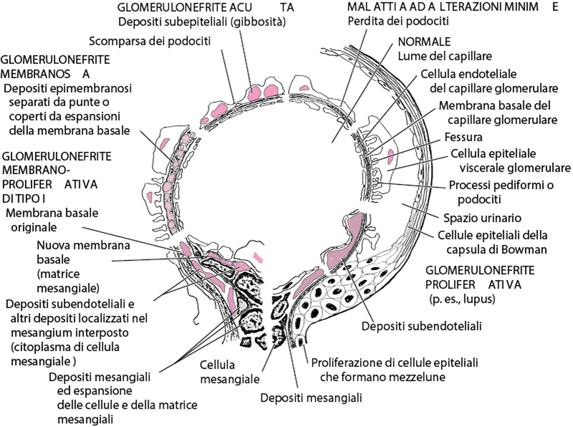 Caratteristiche in microscopia elettronica nelle patologie immunologiche glomerulari