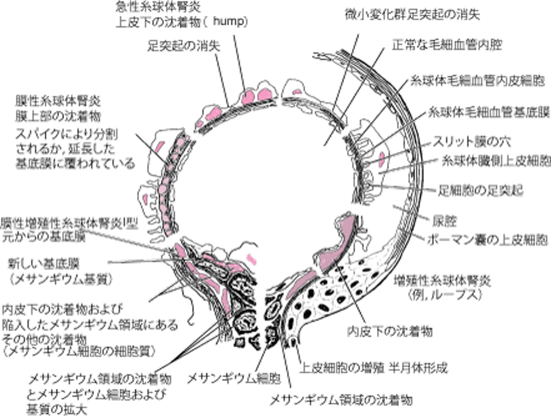 免疫性糸球体疾患の電子顕微鏡所見