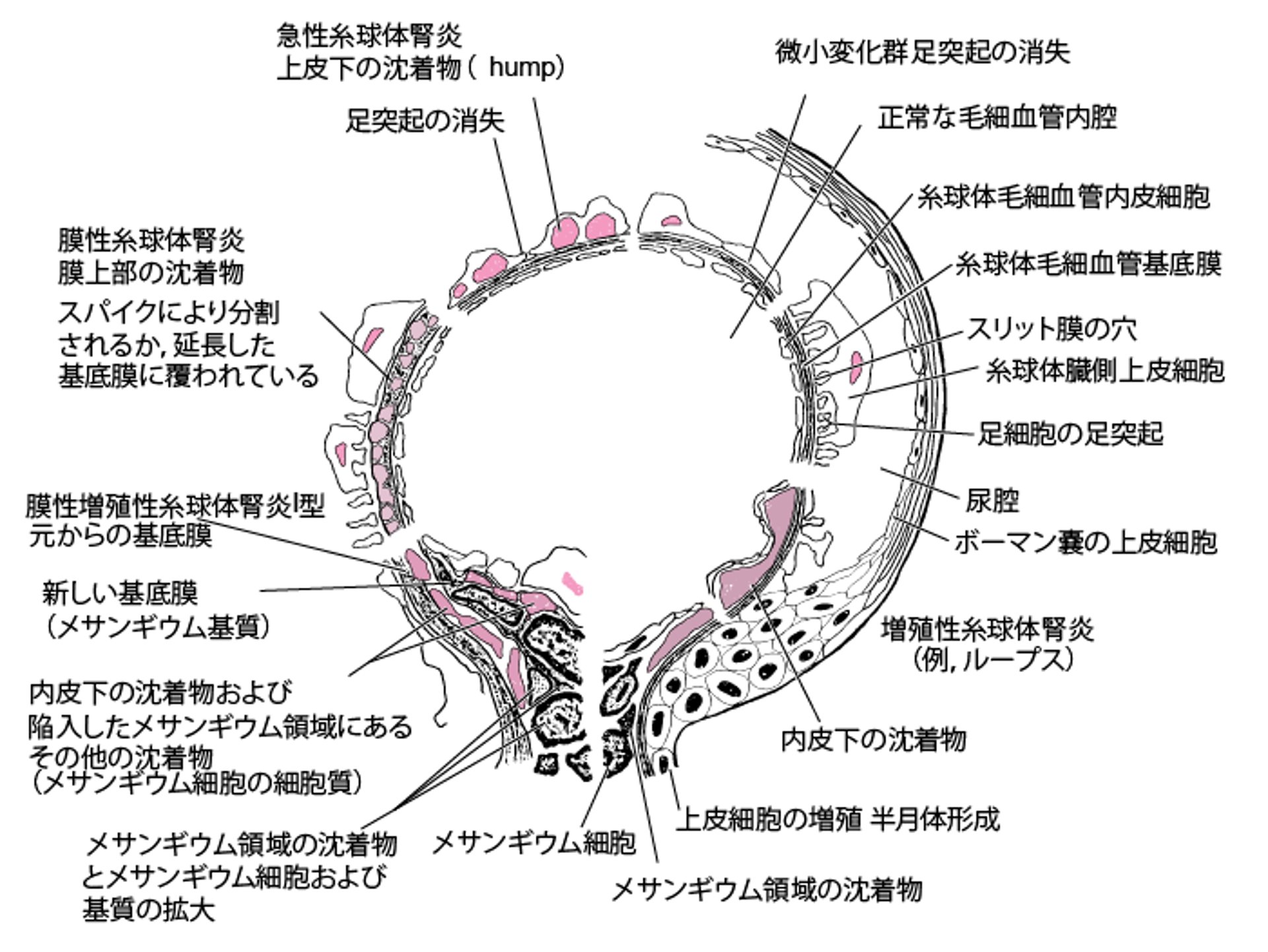 免疫性糸球体疾患の電子顕微鏡所見