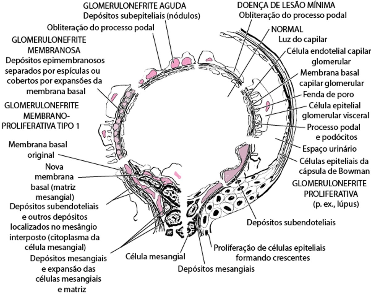Características da microscopia eletrônica nas doenças glomerulares imunológicas