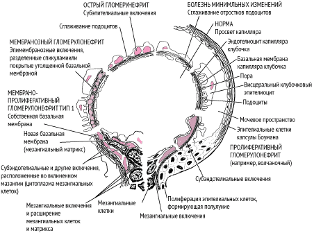 Признаки иммунологической гломерулярной патологии при электронной микроскопии