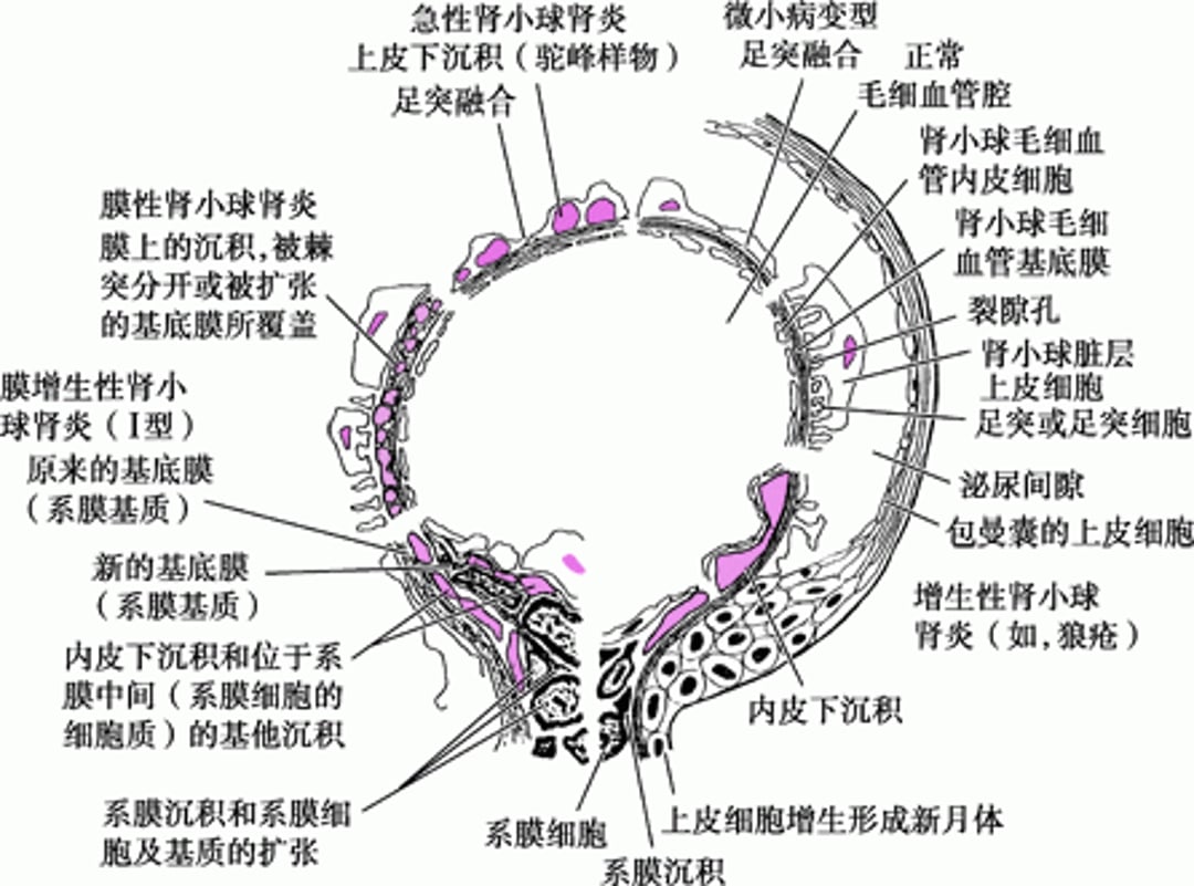 免疫性肾小球疾病的电镜表现
