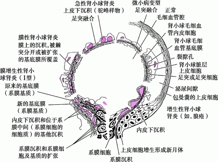 肾炎综合征概论 - 泌尿生殖系统疾病 - MSD诊疗手册专业版