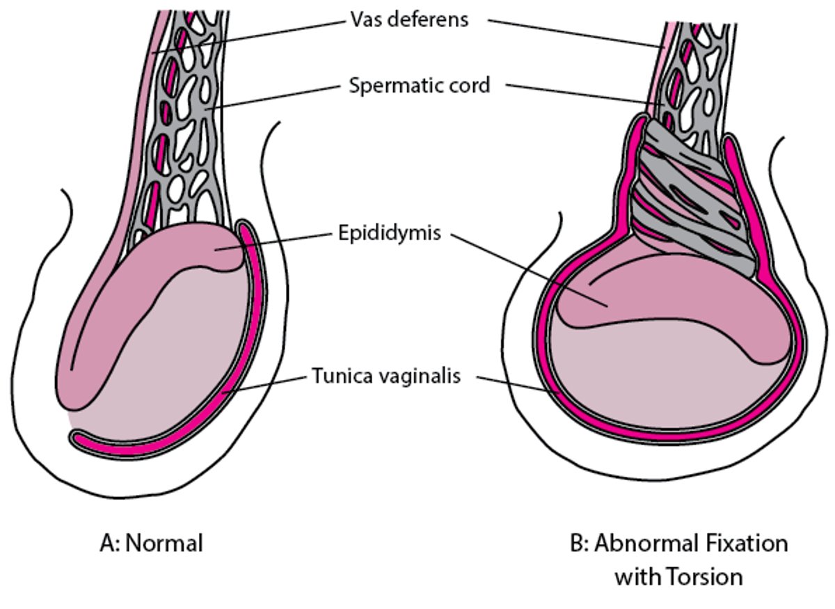 Abnormal testicular fixation leading to torsion