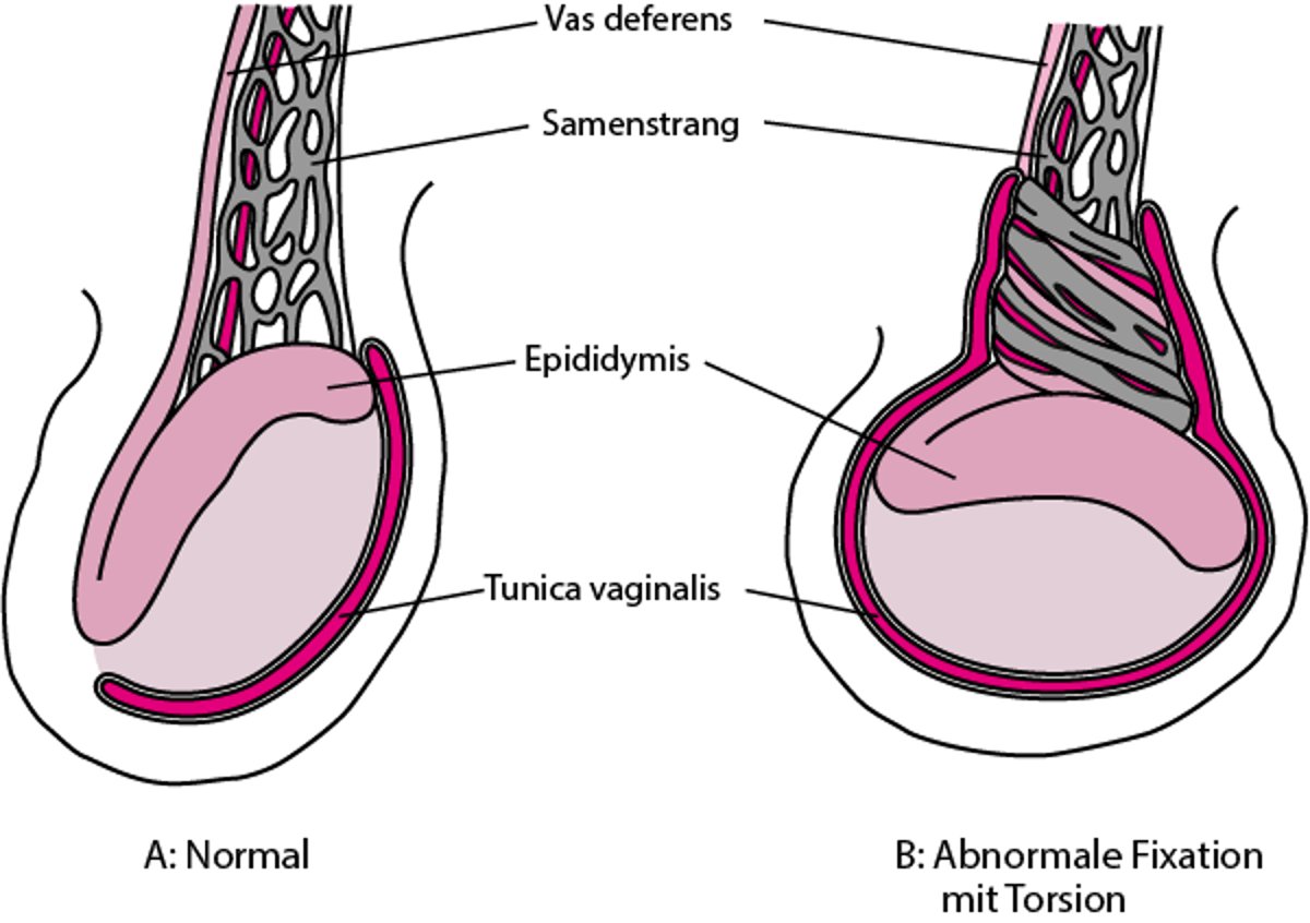Eine anomale Hodenfixierung führt zu Torsion