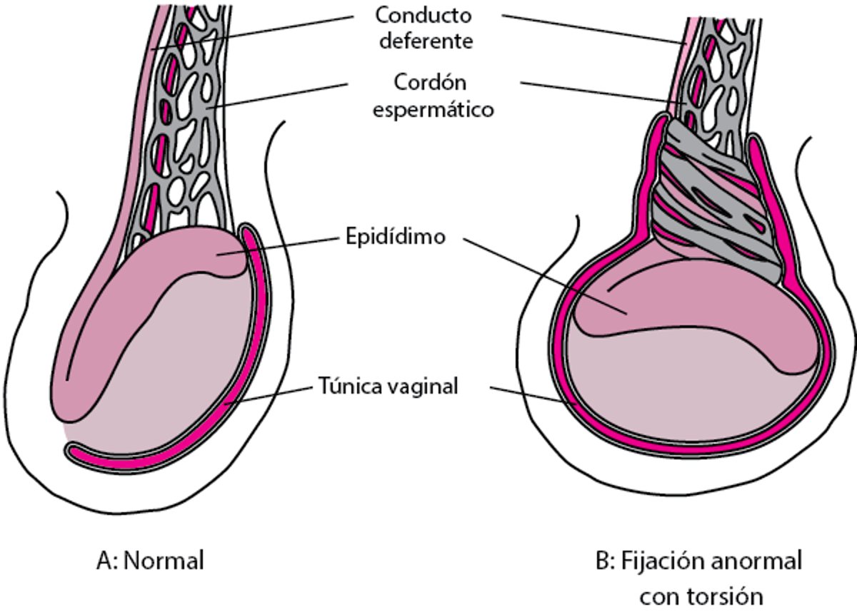 Fijación testicular anormal que lleva a la torsión