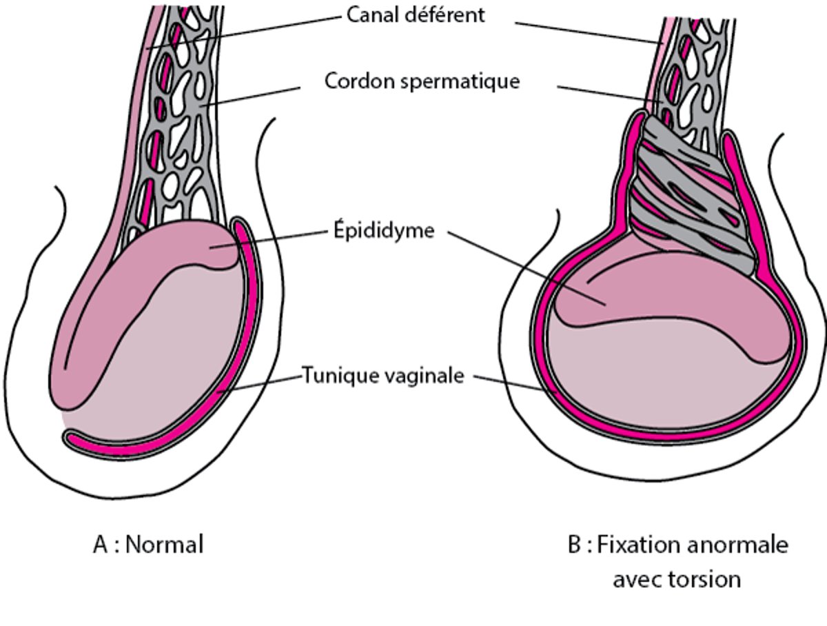 Fixation testiculaire anormale aboutissant à une torsion