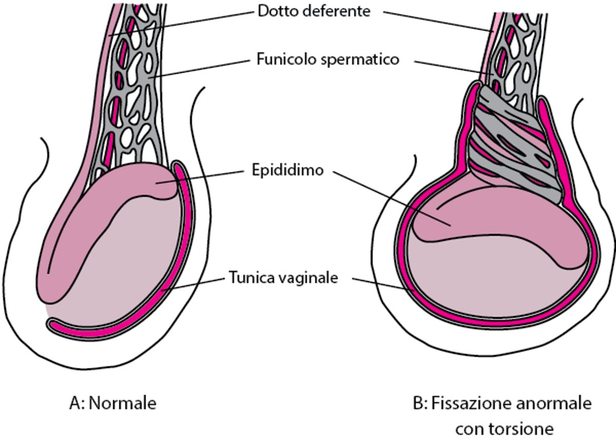 Il fissaggio testicolare anormale porta alla torsione