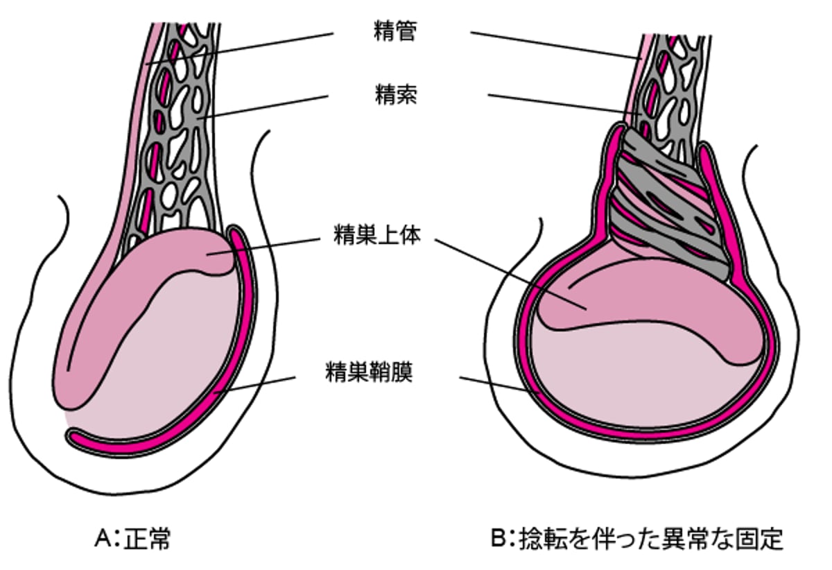 精巣捻転につながる精巣固定の異常