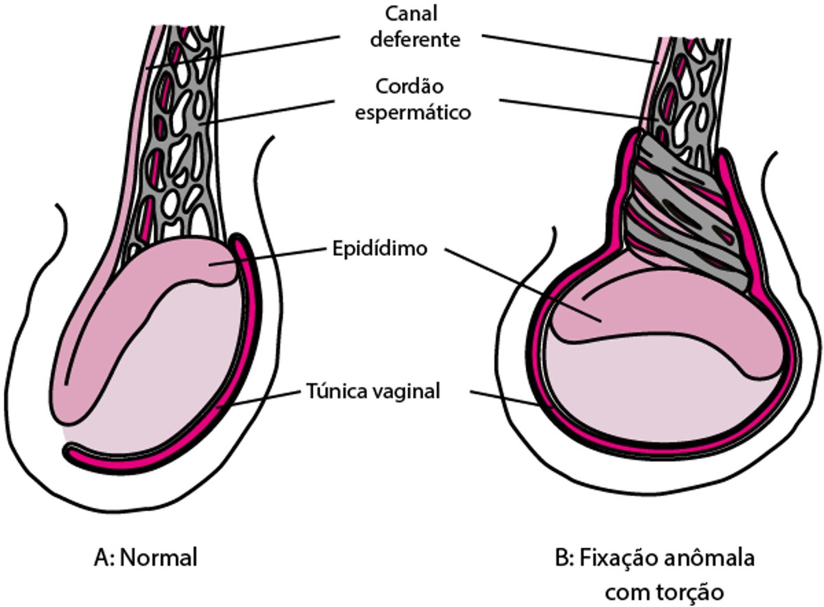 Fixação testicular anormal levando à torção