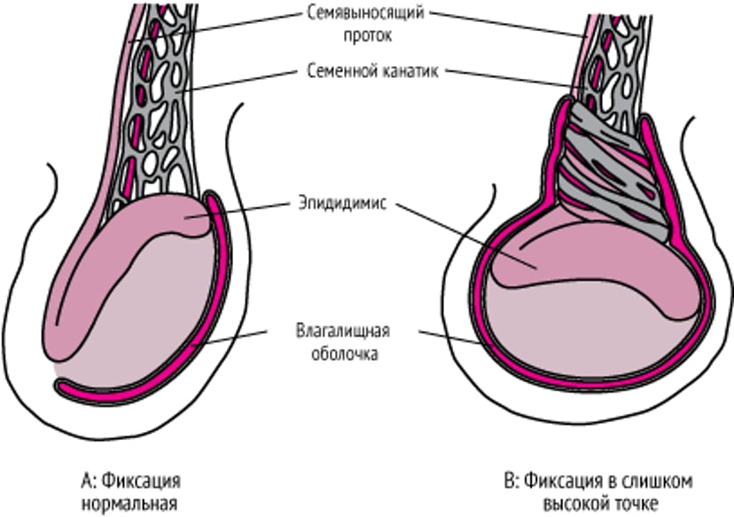 Аномальная фиксация яичка, приводящая к перекруту