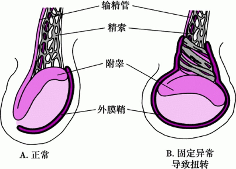 睾丸固定异常导致的扭转