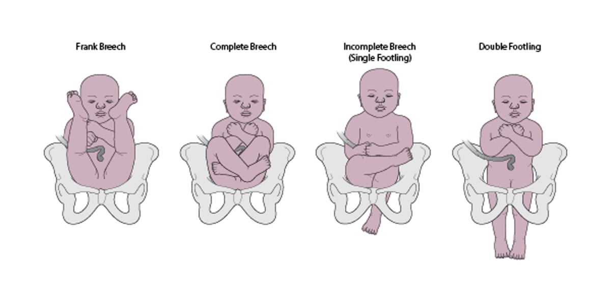 Types of breech presentations